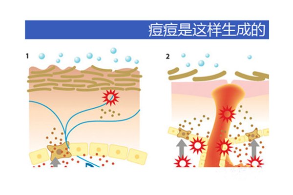 長痘就是排毒嗎？后青春期爆痘多數是過敏